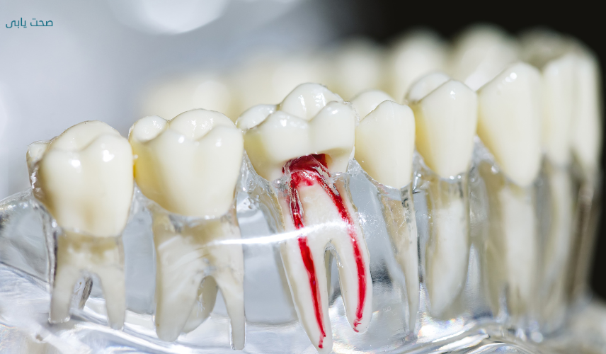 Root Canal Dentist Islamabad Lahore Karachi Peshawar Sehatyabi.pk